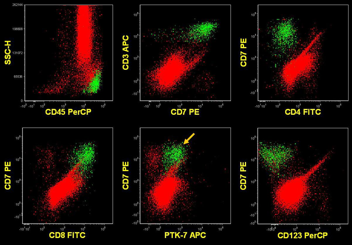 Flow cytometric analysis of BM sample at second relapse (2/2012) showing abnormal T-cells (green)